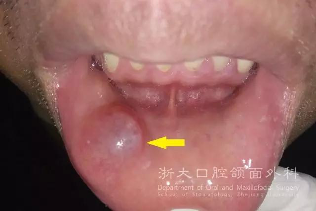 黏液囊肿图片下唇黏液囊肿,常为绿豆或黄豆大小,大的也可占据半个嘴唇
