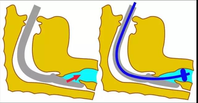 于是brain在1997年设计出气管插管型喉罩通气道(intubating laryngeal