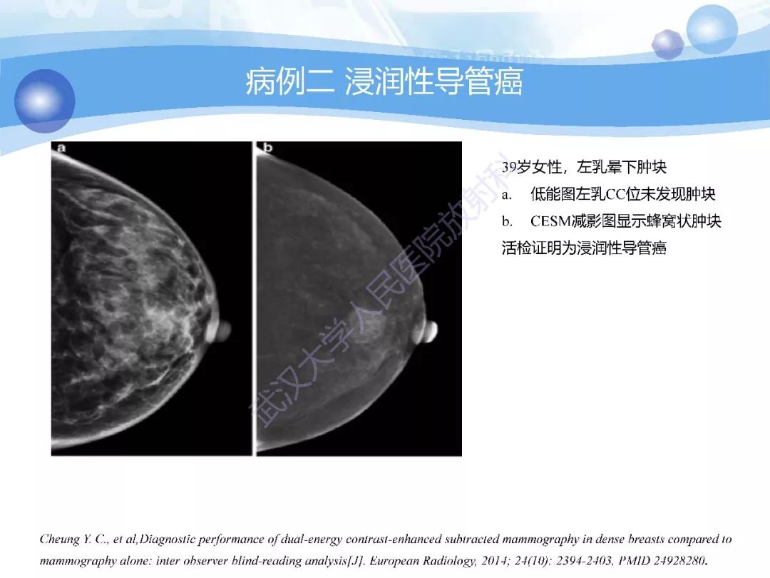 对比增强能谱乳腺x线摄影