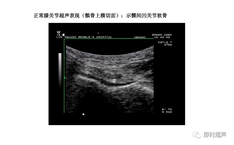 膝关节常见疾病的超声检查