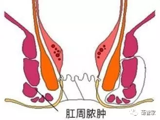 导致肛瘘的主要因素之一是肛周脓肿.