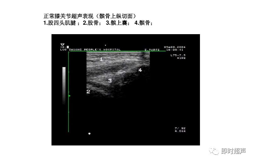 膝关节常见疾病的超声检查