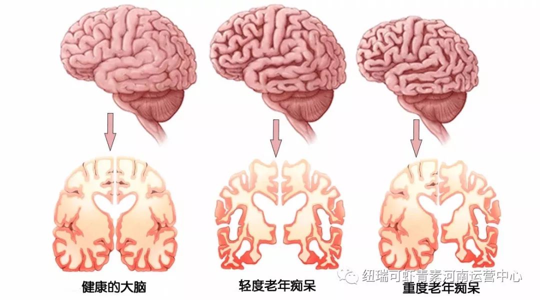 虾青素大讲堂:穿越血脑屏障 保卫大脑健康