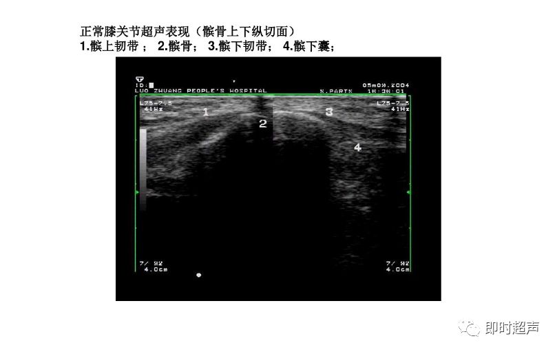 膝关节常见疾病的超声检查