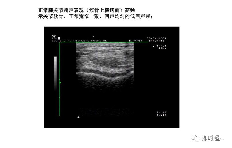 膝关节常见疾病的超声检查