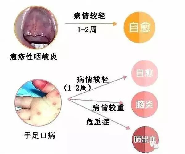 疾病预防 | 疱疹性咽峡炎比手足口病还严重?