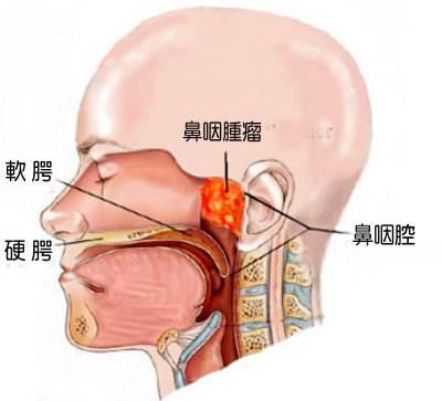 首大刘玉梅:从鼻咽炎到鼻咽癌,比你想象的快!怎么区别?