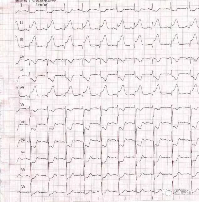 5种常见致命疾病心电图