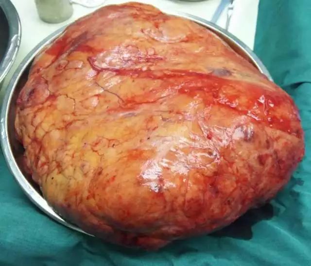 他的肾脏里长了一个8斤重的瘤子.