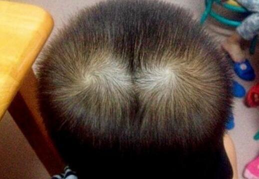 头旋又别称发旋,指的是毛流在头顶可形成一个中心向外,周围头发呈