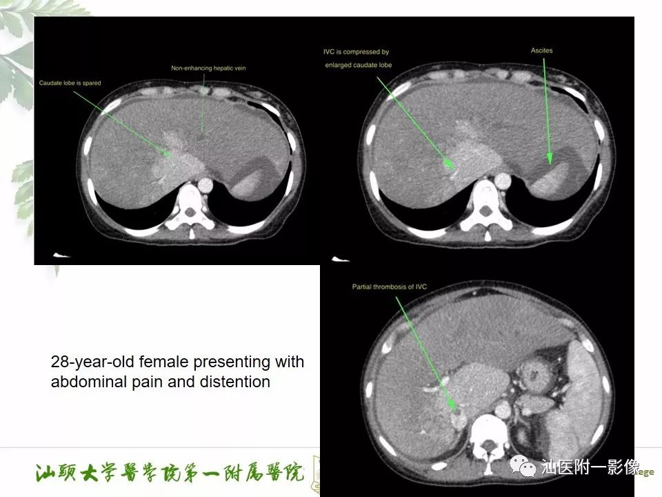 【每日一例| 618例】肝窦阻塞综合征