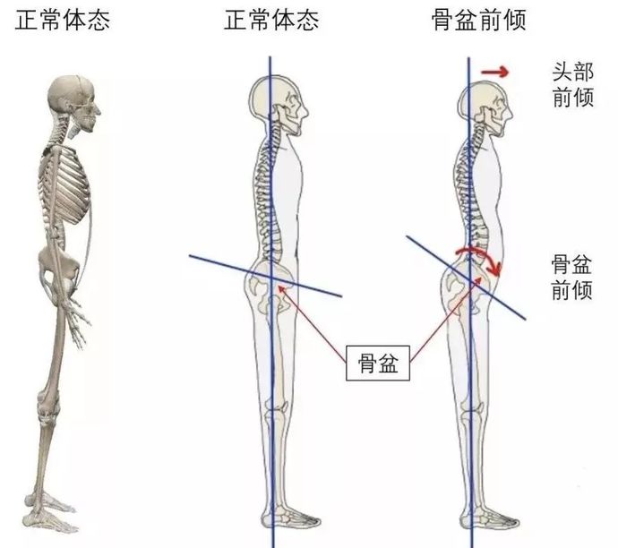 热巴可以说是身材不错的了,除了骨盆前倾▼