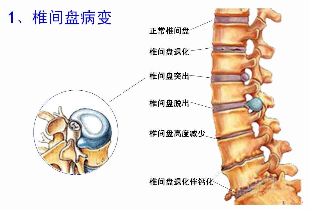 腰椎间盘突出久治不愈,这3个错误还在犯?