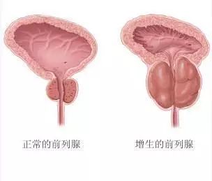 健康 正文  前列腺增生的手术从无到有,从开放到微创,历经百余年.