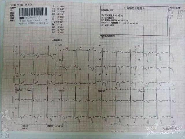 无不适主诉,查体未见阳性体征,血压正常,胸片示心肺未见异常.