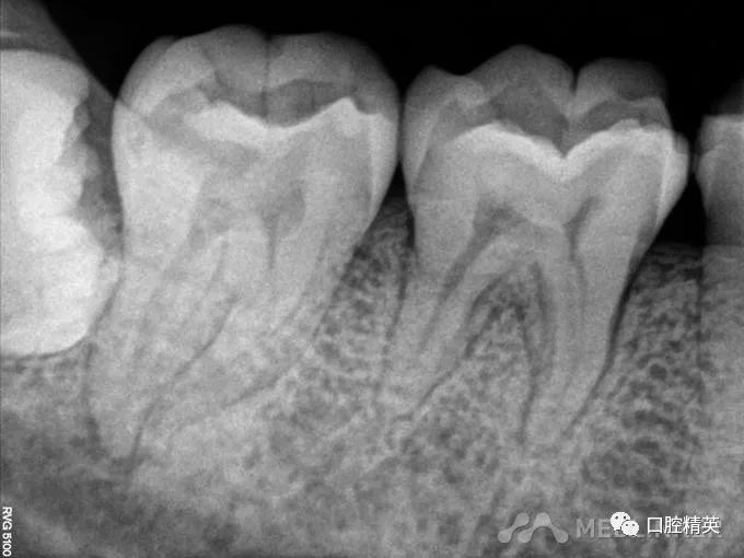 47牙牙髓坏死(原因待查)行47牙根管治疗