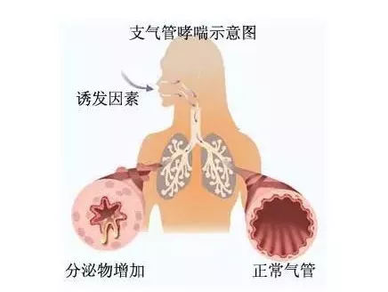 儿童哮喘怎么治?小儿呼吸科专家撰文家长,这些功课要