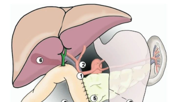 外科医师学习笔记——胰腺切除术后出血