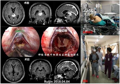 上海瑞金医院神经外科首次对松果体区巨大占位脑瘤实施内镜下全切除术