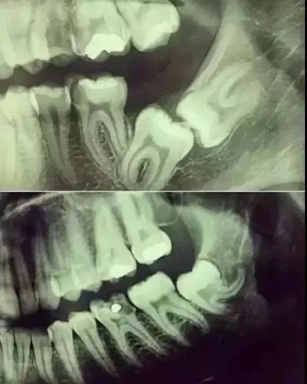 去医院看个牙齿牙医说需要拍个片子,有必要嘛?