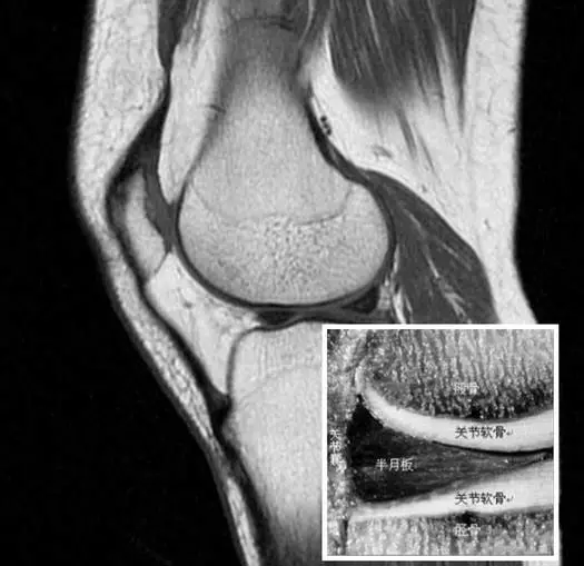 图说半月板