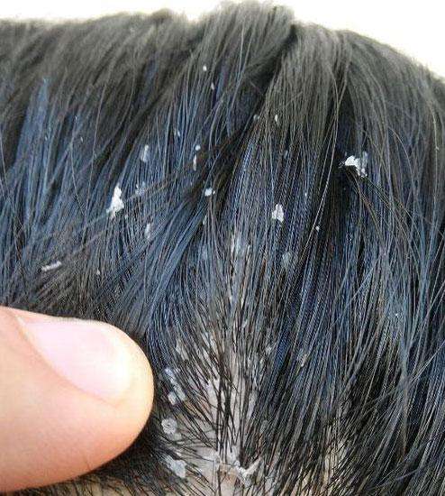 头发油很痒头皮屑多是什么原因导致的