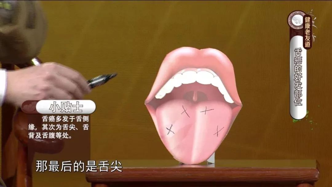 吃小龙虾竟吃出舌癌这些导致舌癌的不良习惯很多人都有