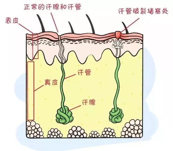 高温下,体表的大量汗液来不及蒸发,时间一长,就把汗腺口的皮肤角质层