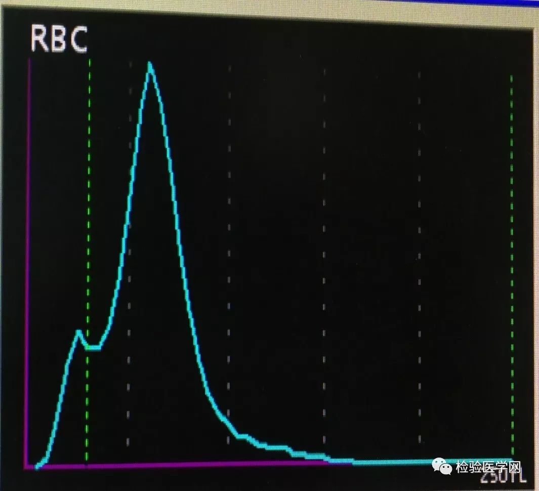 红细胞直方图显示双峰曲线,基线变宽,2群大小不等的红细胞及红细胞