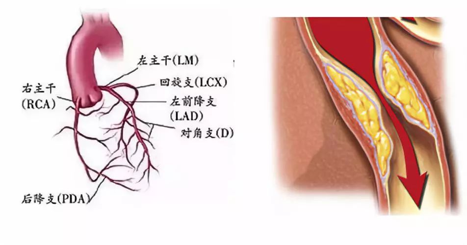 李阿姨送到当地县医院行冠状动脉造影术提示:左前降支近端弥漫性狭窄