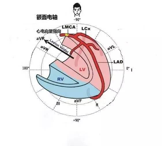 根据此病人的心电图表现,额面 avr 导联 st 段抬高,i,avl,ii,avf 导联