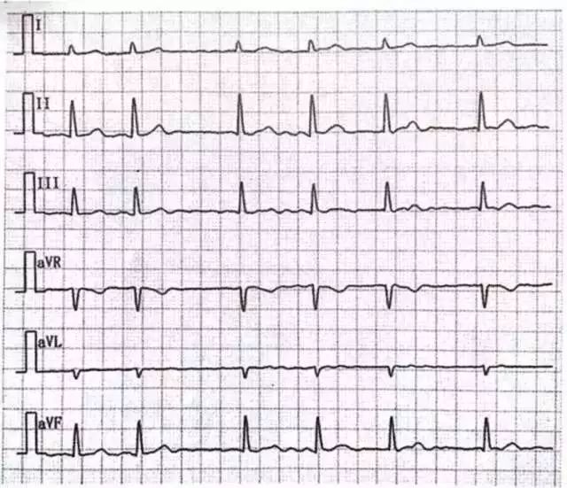 心电图复习全攻略