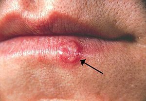 唇疱疹,单纯疱疹病毒1型和2型的杰作