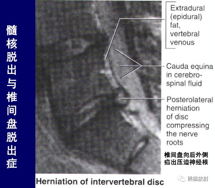 腰椎ct轴位↓ 矢状t2wi及t1wi主要解剖结构:↓ t1wi(脑脊液呈低