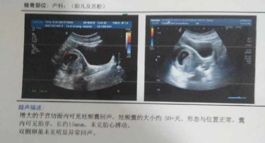 女子怀孕后,做检查却没有胎心!坚持一周后,看到复查结果傻了