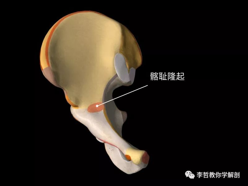 外源性弹响髋:这是最早认识到的类型,由髂胫束摩擦股骨大转子引起.