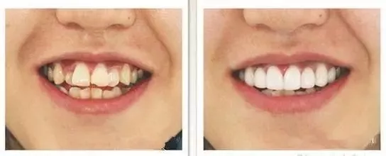 牙列形态异常又不宜做正畸治疗的患者,可考虑做烤瓷牙修复