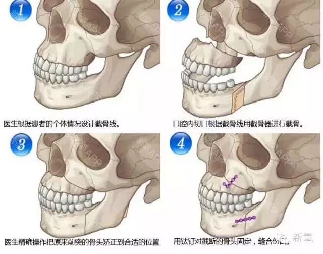 骨性嘴凸:需要正颌,把上下颌骨头给 截断移到合适的位置再固定,手术