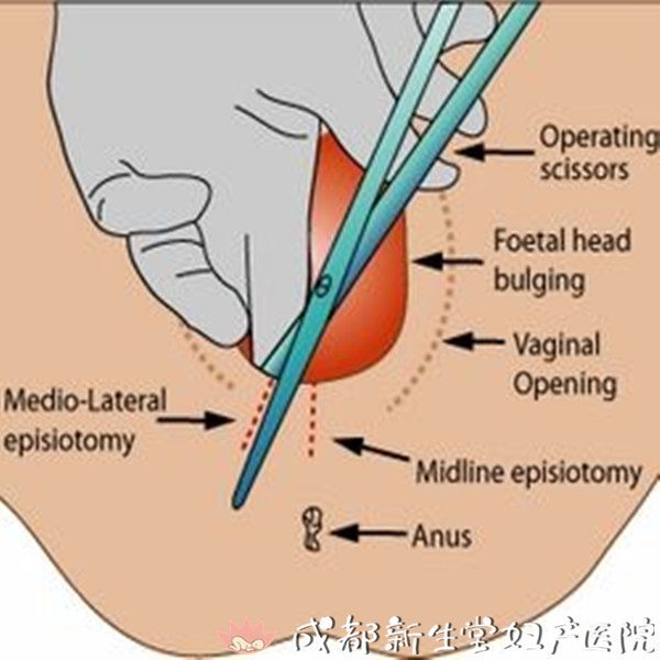 侧切比裂伤更好恢复?顺产哪些情况需要侧切?