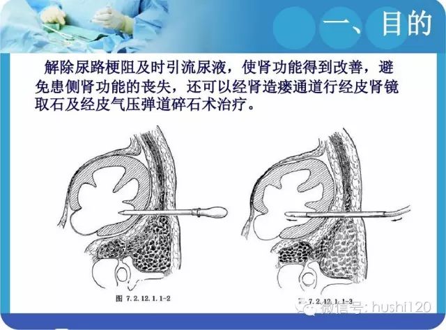 ppt:肾穿刺造瘘术的护理