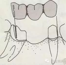 图4-18 远中基牙应用邻面半冠作为固位体图4-19可以使用双套冠作为