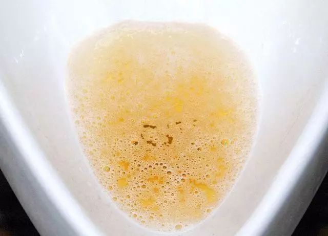 三,泡沫尿肾好的人尿液是一股水柱,而尿液分叉或者慢慢的滴下来,说明