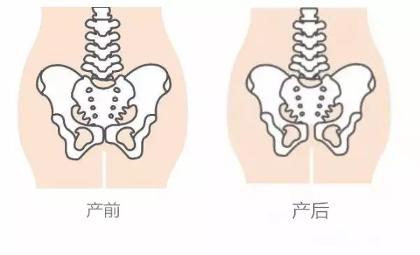 【骨盆修复】那些不做骨盆修复的人,最后都怎么样了?