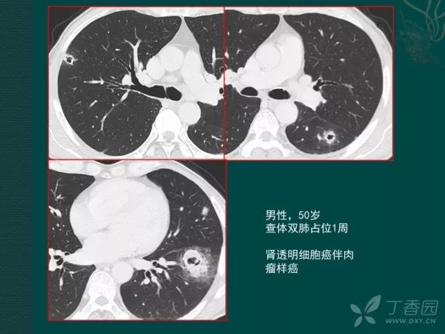 看完这篇,晋级空洞型肺癌诊断高手