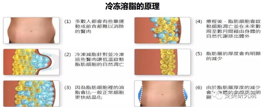 医美| 最划算冷冻溶脂团