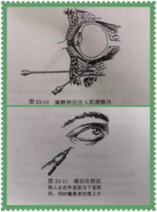 (1)面神经阻滞麻醉:van-lint法,o′brien法,atkinson法 (3)球周麻醉