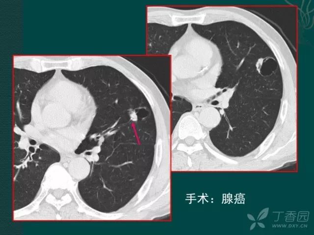 从病理来讲述一下,这两个都是空洞型肺癌.