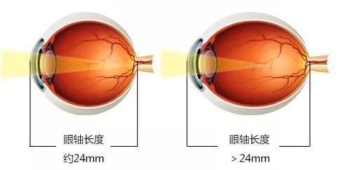我们正常眼球突出度在12-14mm,平均13mm,两眼突出差值超过2mm可认为