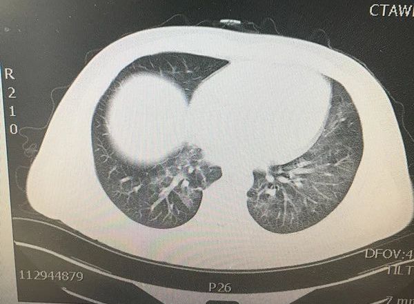 45 岁壮年男性「大白肺,难道是