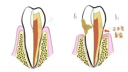 正常人的牙齿是牙根长在牙槽骨内,并且被牙龈包裹得严严实实,仅牙冠